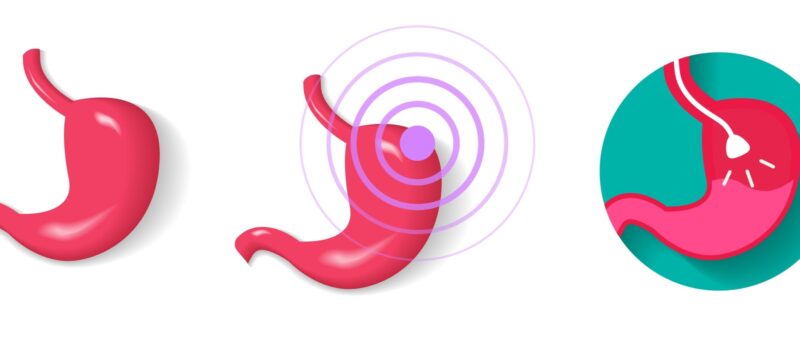 胃がんは抗がん剤治療をどう進める？胃がんで使われる抗がん剤や治療の進め方を解説